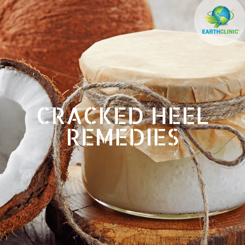 Cracked Heel Remedies